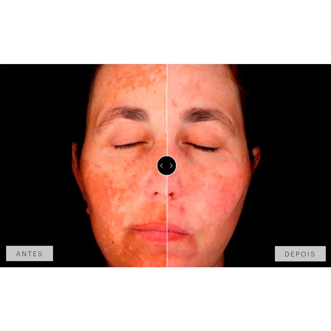 Mesoestetic Dermamelan Treatment pigment Control 30g 1.06oz 9 Mesoestetic Dermamelan Treatment pigment Control 30g 1.06oz - Image 7